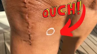 Pain on the Inside Edge of Knee After Total Knee Replacement