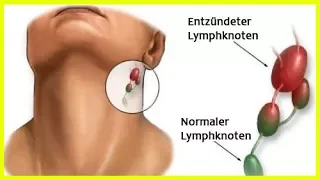 Entzündung der Lymphknoten