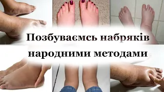 Набряки ніг, тіла, на обличчі - причини, як позбутись - народні методи лікування.