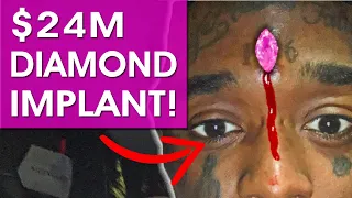 Lil Uzi Vert Face SWOLEN After Getting $24M Diamond IMPLANTED In Forehead!