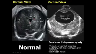 Fetal Brain Ultrasound Normal Vs Abnormal Image Appearances Comparison | Fetal Brain Pathologies USG