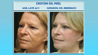 Croton Oil Peel- The Secret Hollywood Peel that Removes Wrinkles