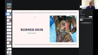 BFIRST Burns Webinar - The Abdomen following Burn injury