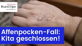 NRW: Kita wegen Affenpocken-Fall geschlossen