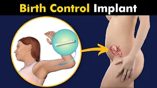 Birth control Progestin Implant / Contraceptive implant