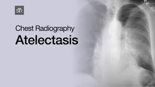 Chest Radiography: Atelectasis
