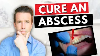 Dentist Explains a Tooth Abscess | How to Cure an Abscess Tooth