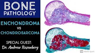 Chondrosarcoma vs Enchondroma: Bone Pathology with Dr. Andrew Rosenberg