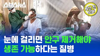 [N년 전 5월 27일] 한국에도 감염자 있다는 치사율 50% 털곰팡이, 사람 간 전염될까? / 스브스뉴스