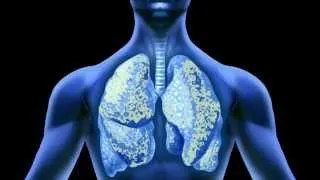 Effects of Asbestos on the Lungs