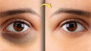 Get Rid of Dark Circles Fast: Effective Remedies and Tips You Need!