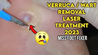 LASER TREATMENT OF A PAINFUL FOOT WART / VERRUCA [2023] BY FAMOUS FEETT SPECIALIST MISS FOOT FIXER