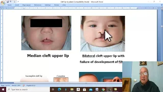 Head and neck surgery in Arabic 1 ( Cleft lip ) , by Dr. Wahdan .