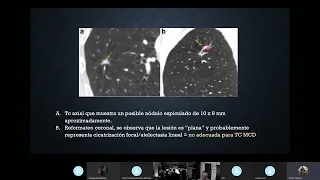 Caracterización de Nódulos Pulmonares mediante contraste dinámico en TC