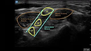 Ultrasound guided interscalene and supraclavicular brachial plexus block