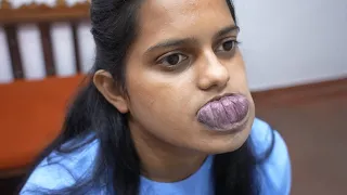 Girl with Large Tumor on lips - Pre Surgery Consultation