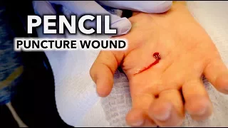 HE STABBED HIS HAND WITH A PENCIL! (puncture wound) | Dr. Paul