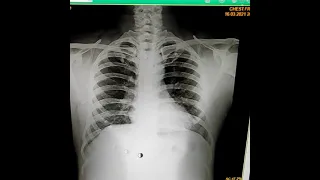 Learn In 5 Minutes CXR Chest X-ray| CXR PA View Complete Practical Video| ChEsT xray