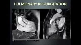 MR assessment of repaired tetralogy of Fallot