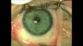 Removal of Sutures from Penetrating Keratoplasty
