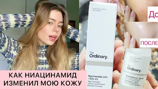 НИАЦИНАМИД | КАК МОЮ КОЖУ ИЗМЕНИЛ THE ORDINARY NIACINAMIDE , как правильно использовать , постакне