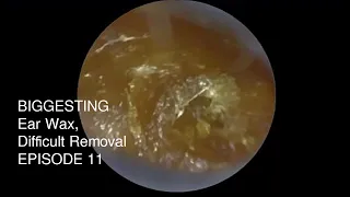 BIGGESTING Ear Wax, Difficult Removal EPISODE 11