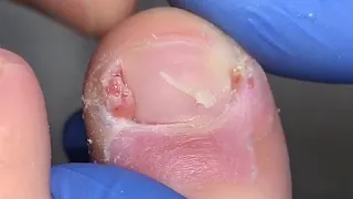 JUICY INFECTED INGROWN TOENAIL REMOVAL [ingrown toenail]