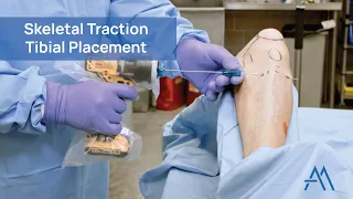 Skeletal Traction - Tibia Placement