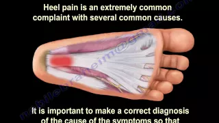 Heel Pain and plantar fascitis , Everything You Need To Know - Dr. Nabil Ebraheim