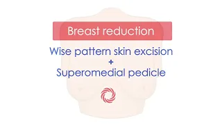 Breast reduction - step-by-step animation