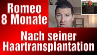 8 Monate Haartransplantation Erfahrung Haarverpfanzung Vorher Nachher