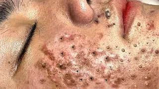 Blackhead Removal With Sac Dep Spa @1000292