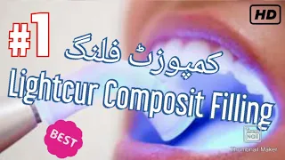 #Lightcure Composit Filling by dental health