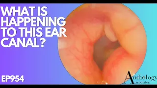 WHAT IS HAPPENING TO THIS EAR CANAL - EP954
