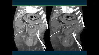 CT Evaluation of GI Bleeding - Part 4