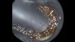 14 - Struggling to perform Ear Wax Removal in Narrow Ears? Watch how the WAXscope®️ can help