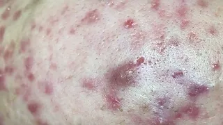 SAC DEP SPA Blackheads | #676