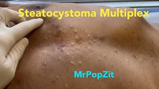 Steatocystoma Multiplex. Dozens of extractions on the chest. Chronic condition. MrPopZit.