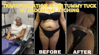 Hourglass Tummy Tuck with Abdominal Etching | Dr.Cortes | Houston Plastic Surgeon