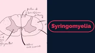 Syringomyelia Rapid Review