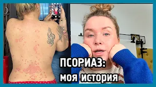 ПСОРИАЗ: кожа, в которой я живу