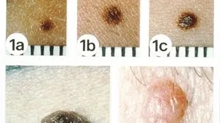 Non-Melanoma Skin Cancers | Skin Cancer