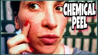 CHEMICAL PEEL Full Process | Procedure | Peeling | Before & After