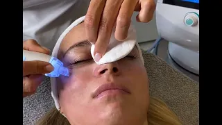 HydraFacial a analýzator stavu pokožky. Smart Ice Blue  ošetrenie Biomatrix