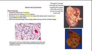 Renal Tumors I Mohammed Al-Khalidi I Pathology Made Easy