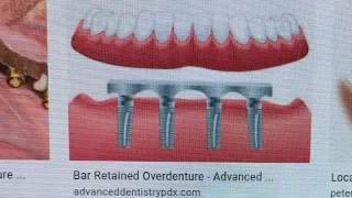 All on 4 versus Bar Overdenture