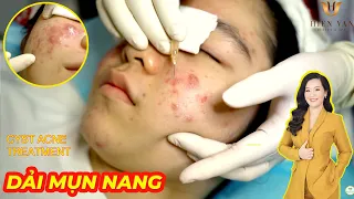 Điều trị mụn nang hiệu quả số 1 TPHCM | Hiền Vân spa | Đỗ Thu Hiền | Cyst Acne Treatment | 650