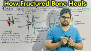 Fracture Healing Process: Repair of Fractured Bone