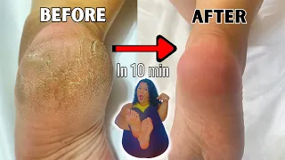 Remove Cracked Heels and Dead Skin from Dry Feet | Natural Home Pedicure