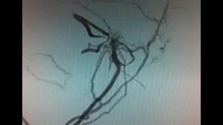 Dural av fistula :Tentorial dural artero-venous fistula with cerebellar drainage